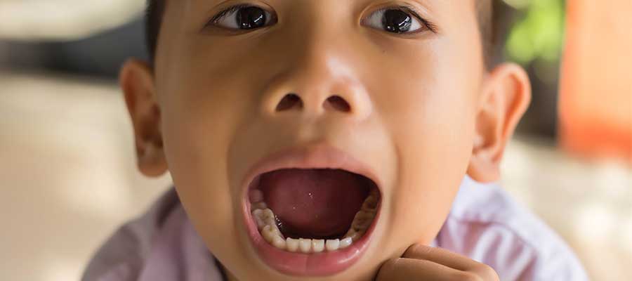 The Reason Some Children are Particularly Prone to Tooth Decay