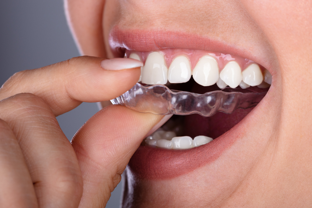 Do clear aligners work?